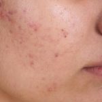 نوشیدنیهایی که موجب بروز آکنه میشوند نوشیدنیهایی که موجب بروز آکنه میشوند